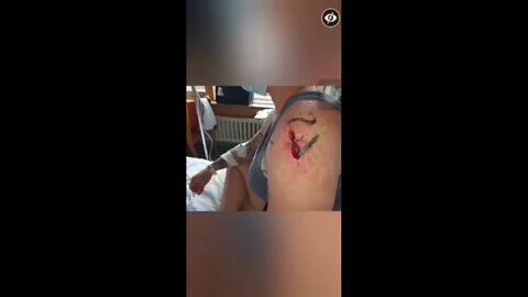 Efectos negativos en el área del pinchazo.