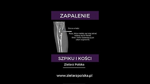 ZAPALENIE SZPIKU I KOŚCI | WYMIANA STAWU BIODROWEGO, KOLANOWEGO | ZANIK CHRZĄSTKI, MAZIÓWKI, MIELINY