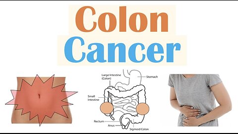 Colon Cancer (CRC) Risk Factors, Pathogenesis, Symptoms, Diagnosis, Staging, Treatment