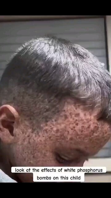 Look what Israel's phosphorous bombs have done to our children.