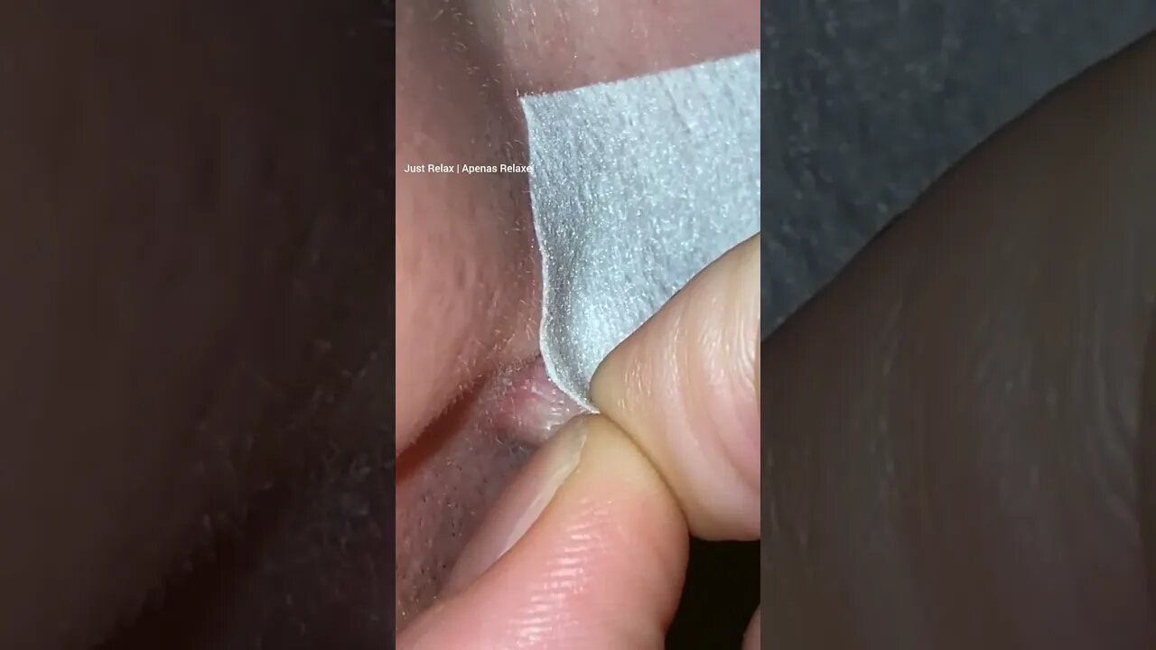 Vídeos Satisfatórios Acne - Just Relax | Apenas Relaxe