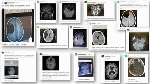 The mRNA Injections gave the Vaxxed a Lobotomy.🕵😳 Wow, they really do have brain damage.😔💔