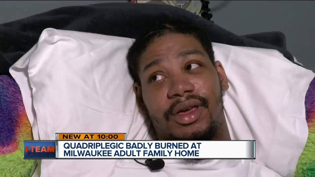 Quadriplegic badly burned at Milwaukee adult family home: I-Team investigates