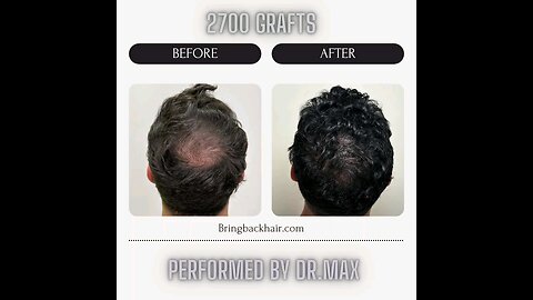 2700 Grafts Progress!