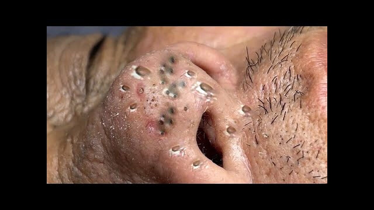 Satisfying Blackheads Extraction and Pimple popper