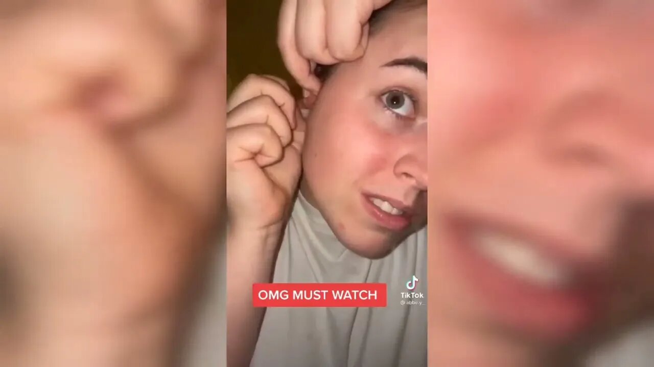 Satisfying Pimple Popping Splinter Blackhead Removing Tiktok compilation