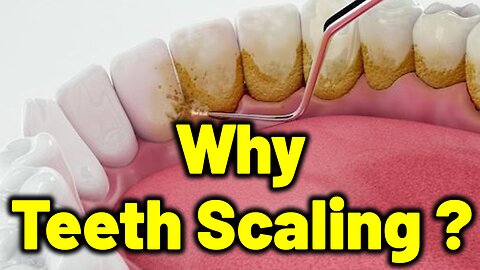 Why scaling is Needed for your Teeth? | Teeth scaling | Dr. Bharadwaz | Dr. Gopikrishna