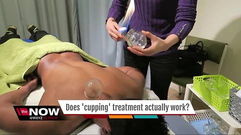 Ask Dr. Nandi: Does 'Cupping' actually work?