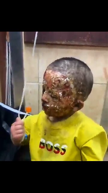 ►🚨▶◾️⚡️🇮🇱⚔️🇵🇸❗️ Meet 4 year old Saja. Israel burnt her body.