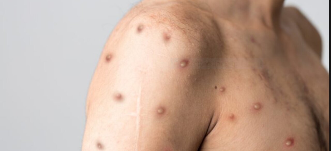 OBSH-ja është gati të shpallë një Pandemi të re dhe të vendosë bllokime në mbarë botën!