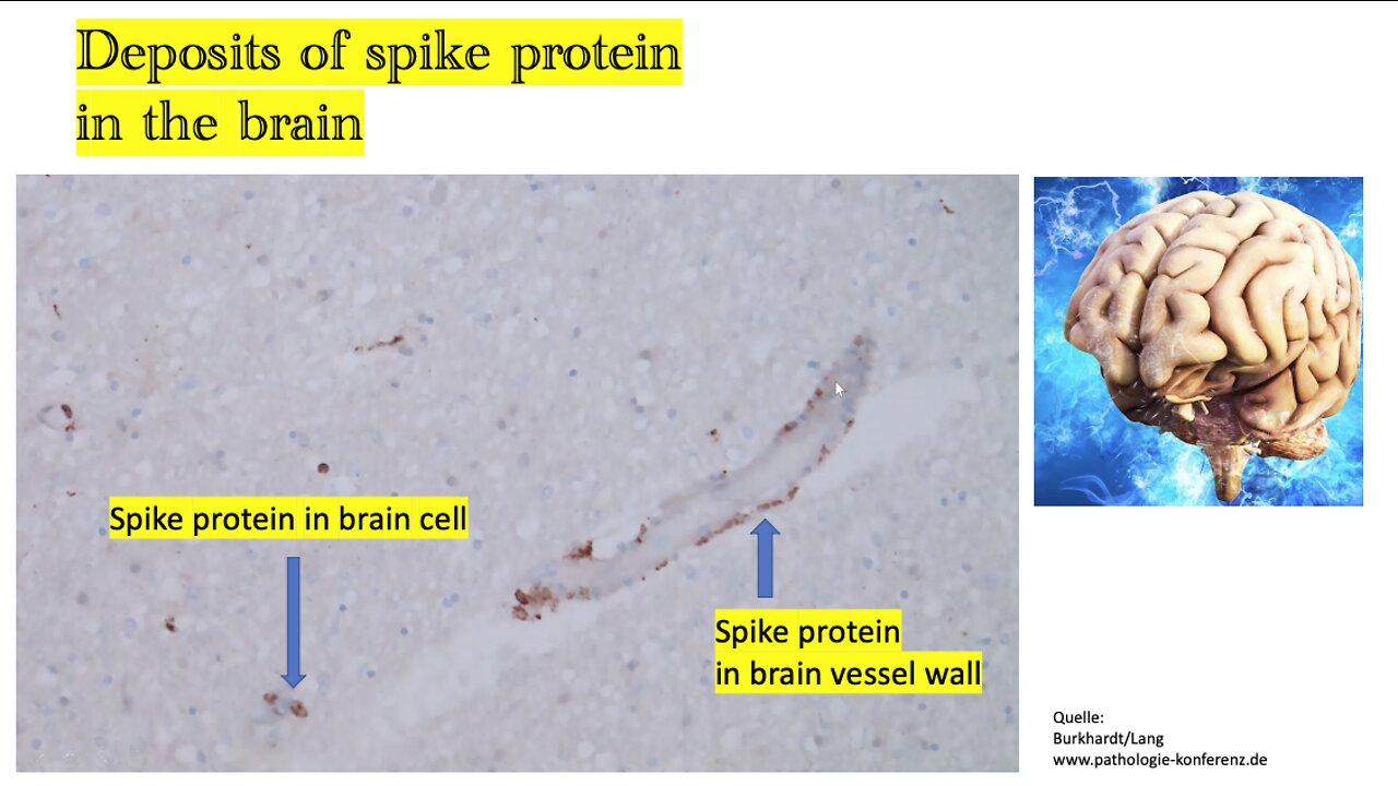 Vaccine induced damage to our vascular system