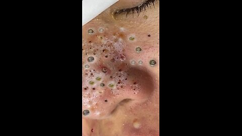 blackhead