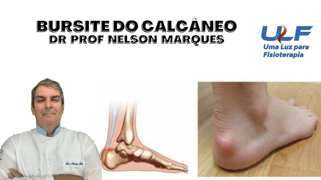 BURSITE DE CALCÂNEO (BURSITE DE AQUILES) - Dr. Prof. Nelson Marques