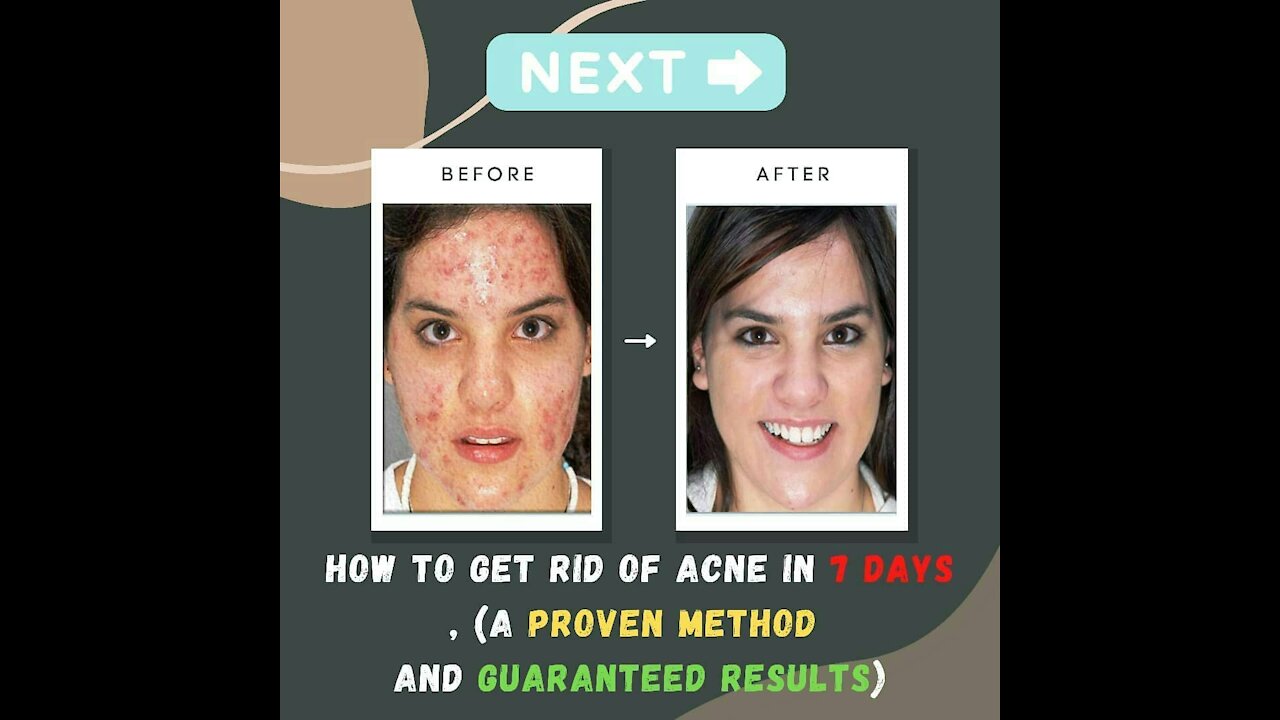 How to get rid of acne in 7 days, (a proven method and guaranteed results)