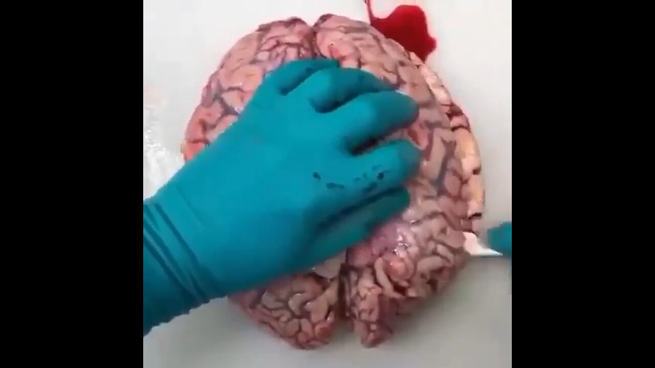 Thromboses in the brains of people killed by vaccine 💉💉💉