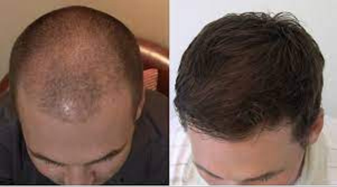 Folifort Reviews - Does This Hair Growth Supplement Work For You & Is Folifort Ingredients Safe?