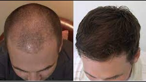 Folifort Reviews - Does This Hair Growth Supplement Work For You & Is Folifort Ingredients Safe?