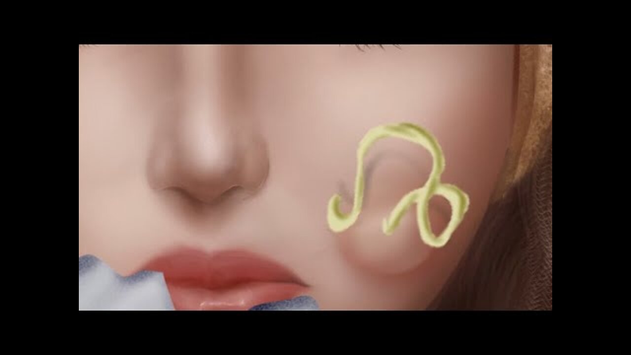 [ ASMR ] get big blackhead ¦ Clear acne for Ana #animation asmr for sleep