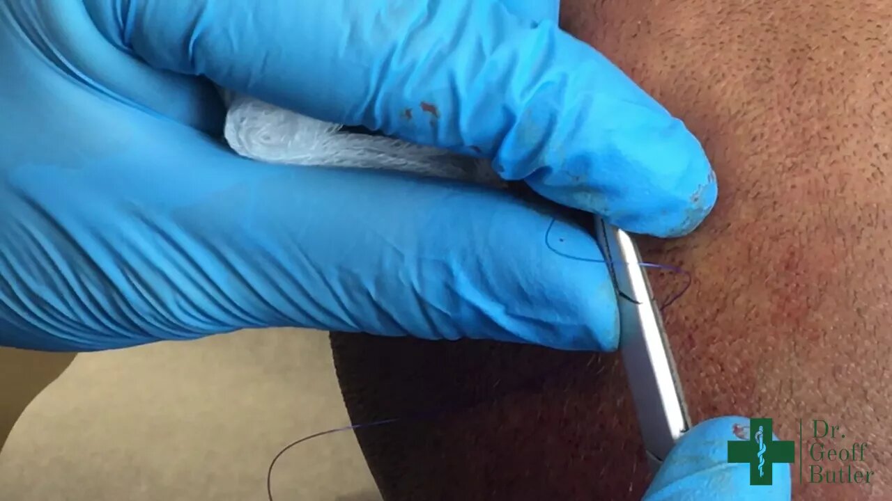 Removal of a PIlar cyst underneath an old scar