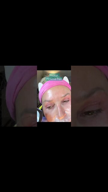 FIBROBLAST SKIN TIGHTENING! #shorts #facialtreatment