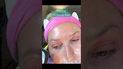 FIBROBLAST SKIN TIGHTENING! #shorts #facialtreatment