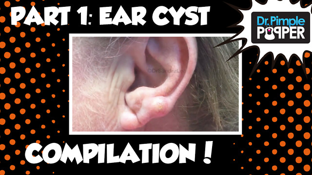 Ear Ya GO! 👂🏽Ear Cyst Compilation Part I