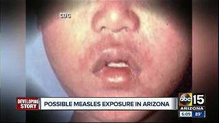 Tourist infected with measles visited Arizona