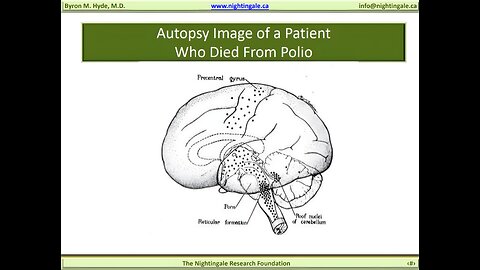 Poliomyelitis vs Myalgic Encephalomyelitis (M.E. is a form of Poliomyelitis with a different name) - Byron Hyde, MD