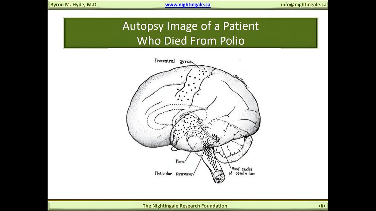 Poliomyelitis vs Myalgic Encephalomyelitis (M.E. is a form of Poliomyelitis with a different name) - Byron Hyde, MD