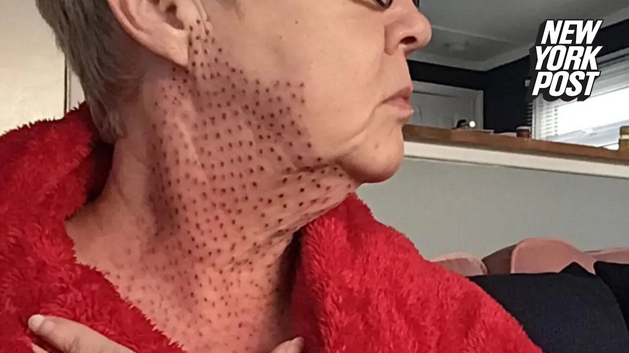 Beauty treatment 'nightmare': I got a procedure to fix my double chin and ended up with 'lizard' neck