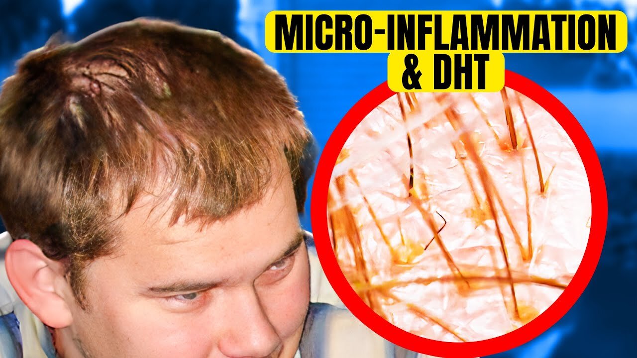 How Microinflammation and DHT Sensitivity Weakens Follicles