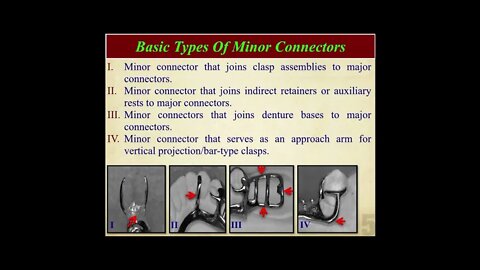Prosthodontics L9 (Minor Connectors)