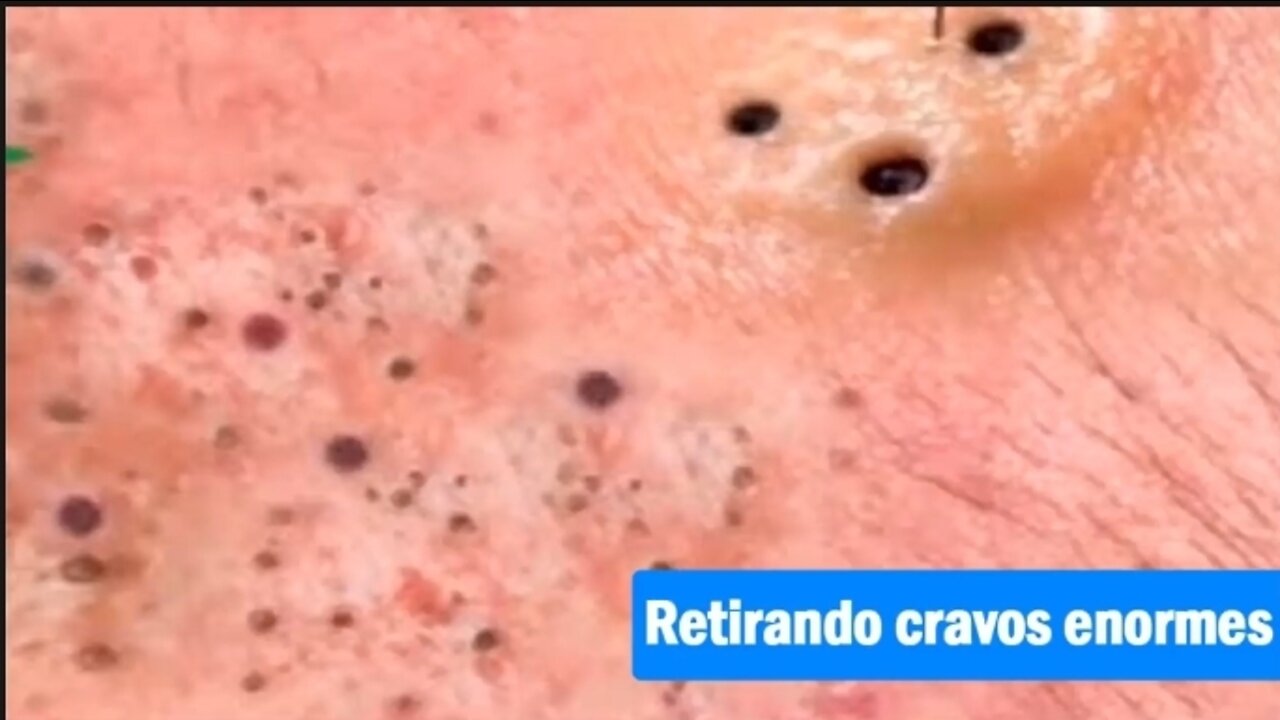 #1 Removing old blackheads and blackheads. satisfying video