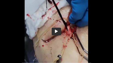 This is NOT Normal!! Removed from a Vaxxed body after death!