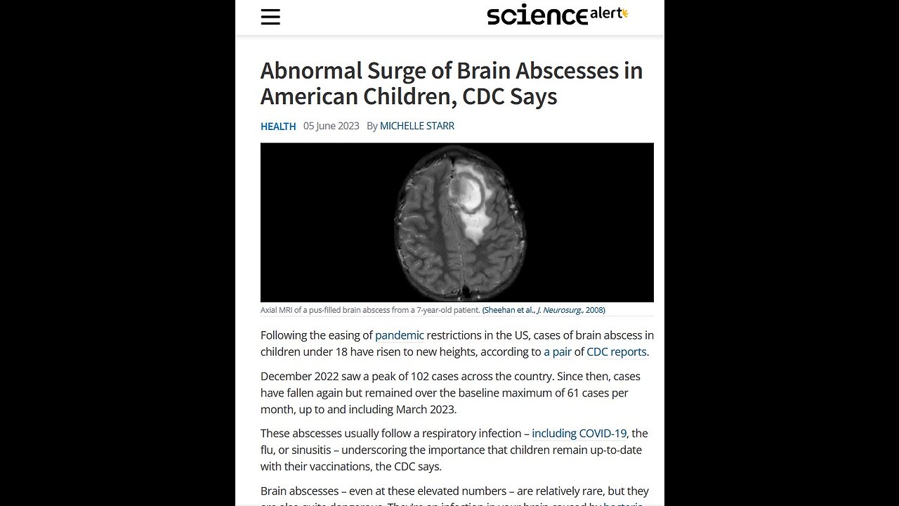 Abnormal Surge of Brain Abscesses in American Children, CDC Says