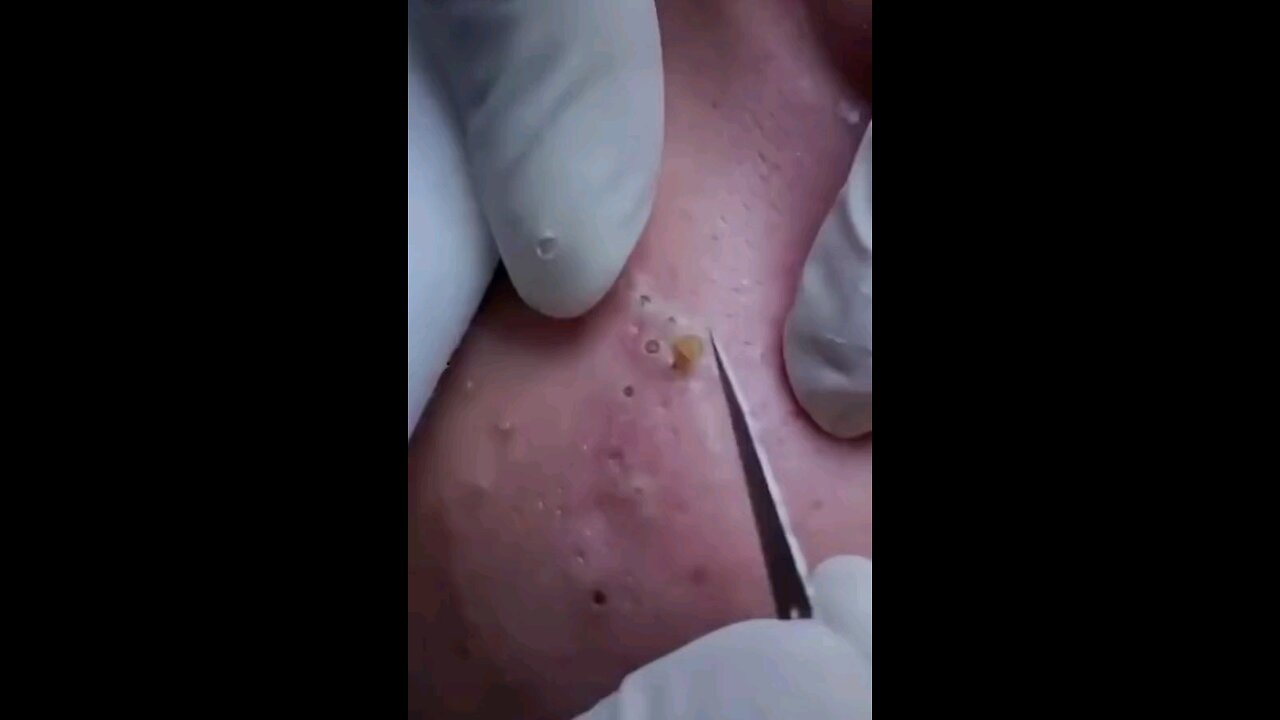 Blackheads episode 3