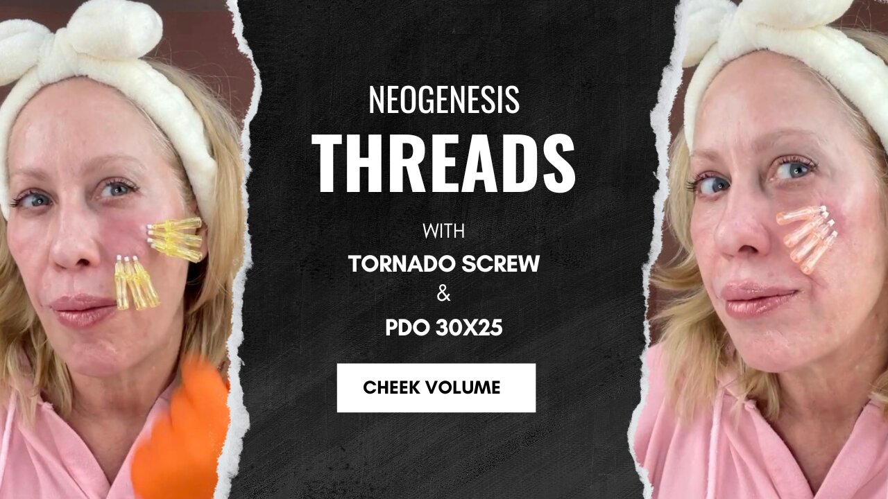 Cheek Volume using Threads