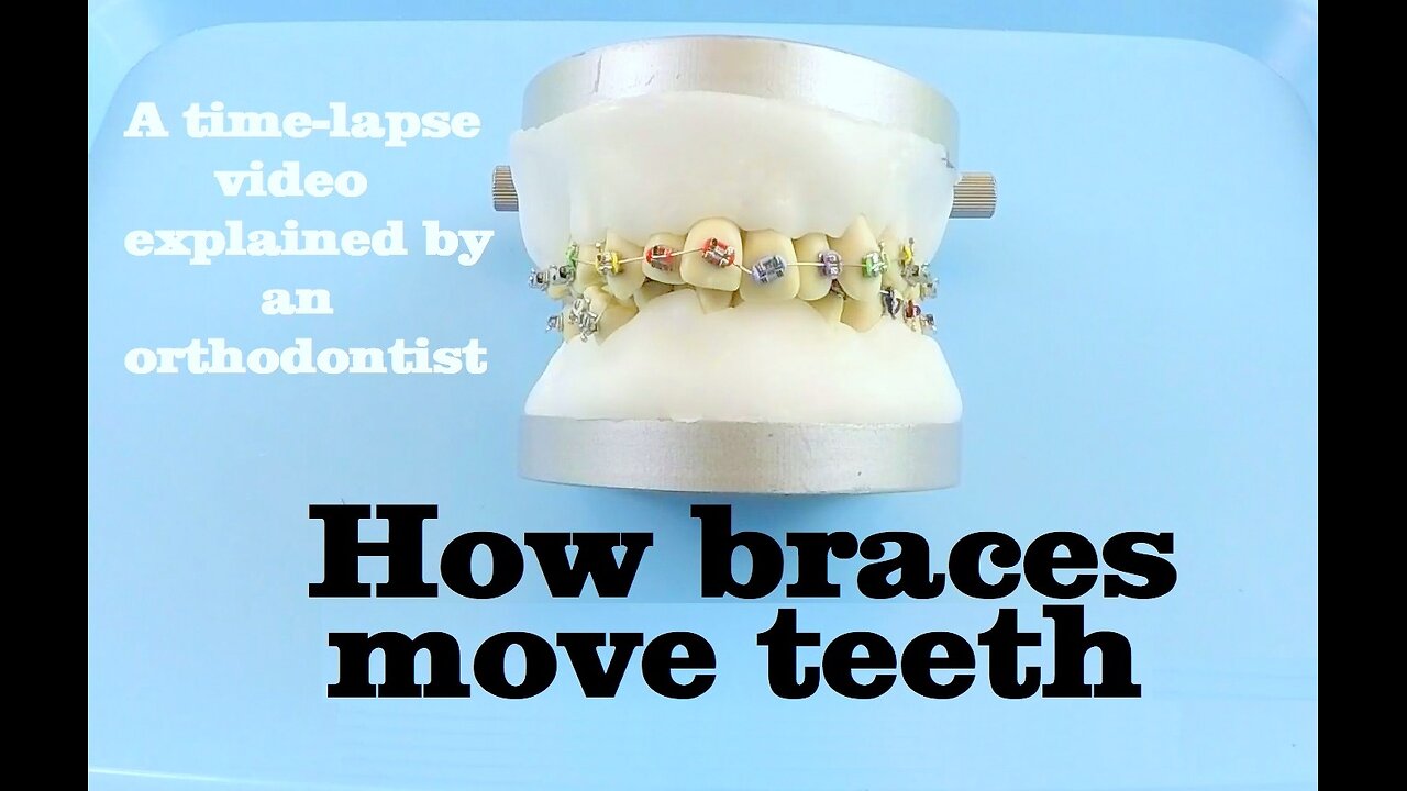 How braces move teeth