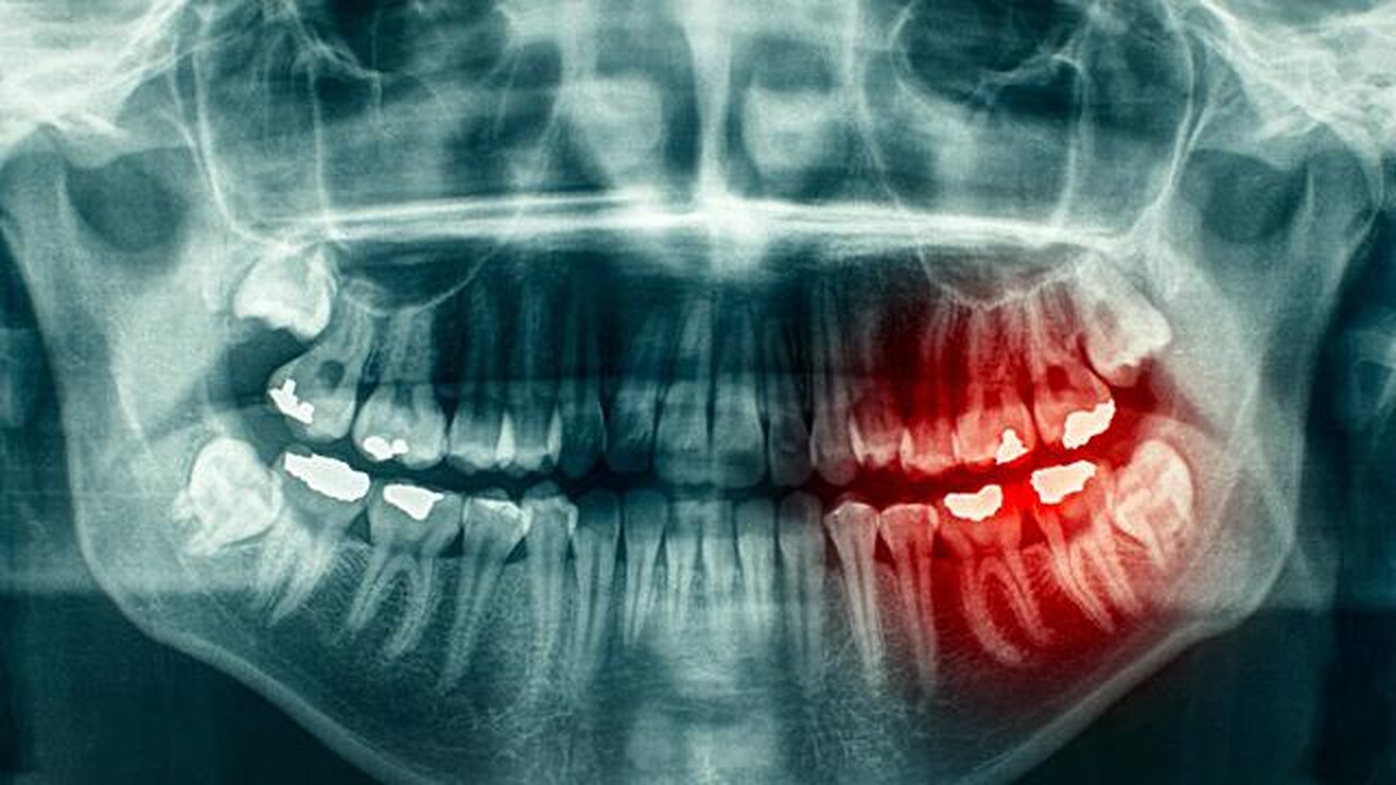 Mercury, Root Canals And Implants - Oh My! - Blanche Grube, DMD, IMD