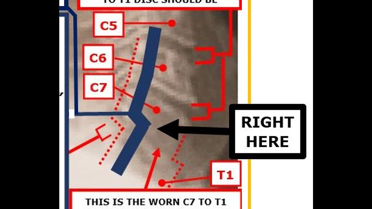 All You Need To Know About Parkinson's, MS, Tremors & The Spine.