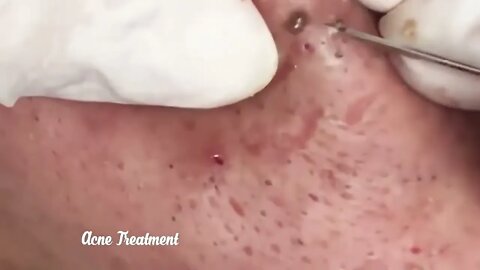 Satisfactory Video Blackhead Removal Skin Cleansing #3 | 2022 Video