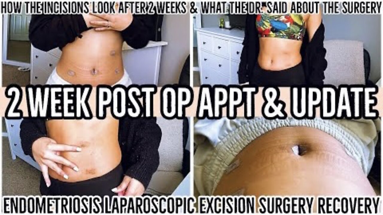 2 WEEK POST OP APPT & RECOVERY UPDATE 2021 | ENDOMETRIOSIS LAPAROSCOPIC EXCISION SURGERY | ez tingz