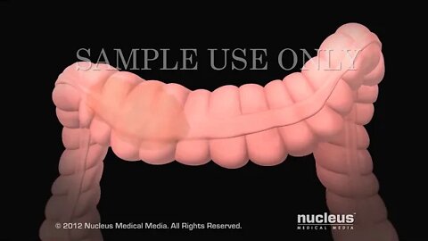 Síndrome del intestino irritable (SII)