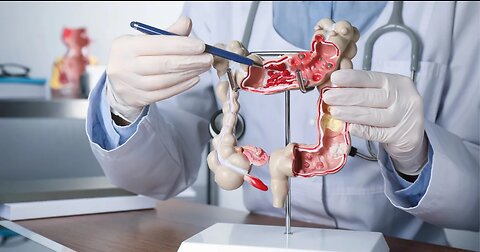 How to Prevent Colorectal Cancer