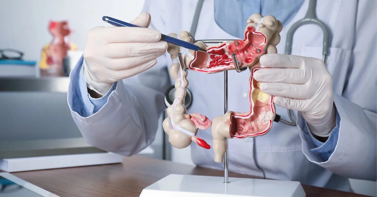 How to Prevent Colorectal Cancer