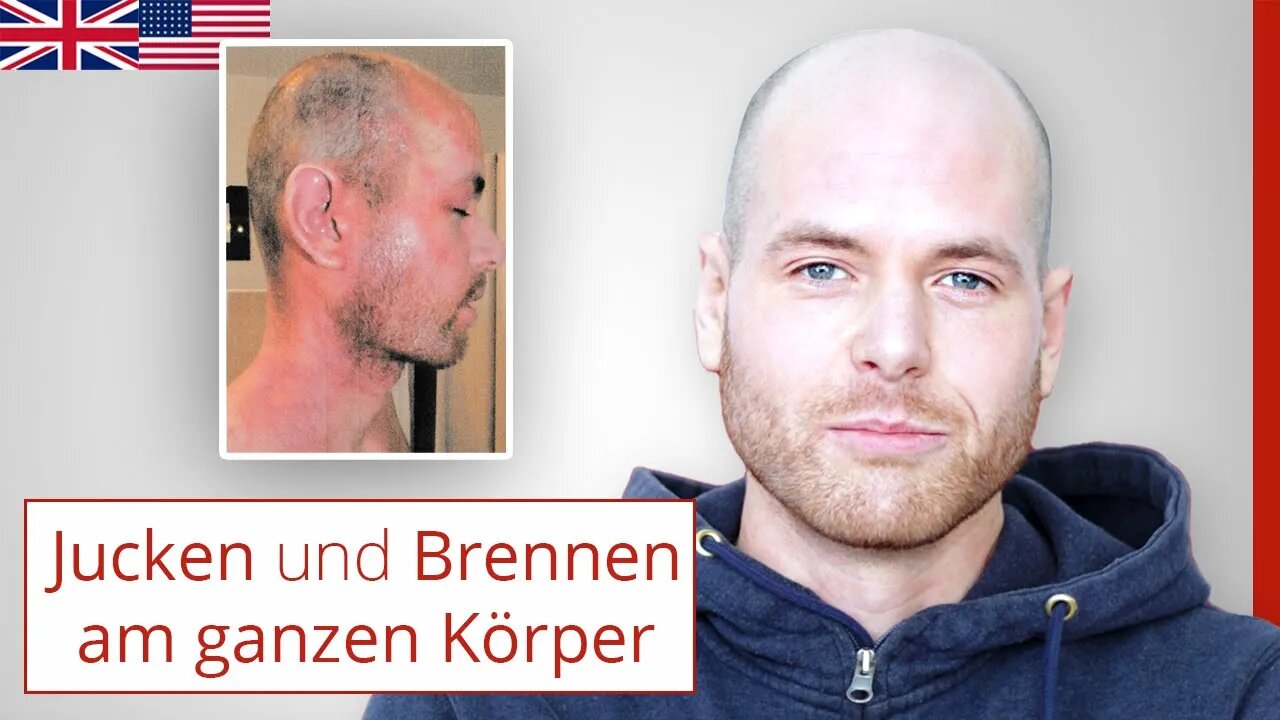 Extreme neurodermatitis: presentation of a patient case in apheresis and NICO remediation