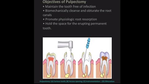 Pedodontics L6 Part1 (Apexogenesis : Pulpectomy & Apexification)