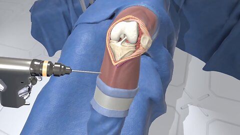 Surgeon Simulator...That's how Doctors perform Surgery for Knee replacement.