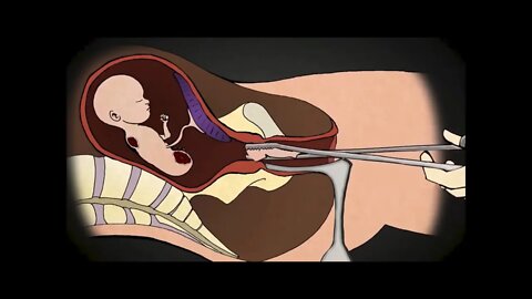 Fetal Infanticide Explained — Only Evil People Support This