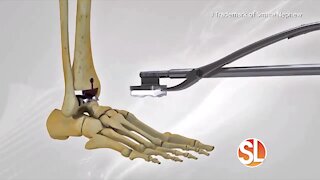 Phoenix Foot and Ankle Institute explains how they do a total ankle replacement for ankle arthritis